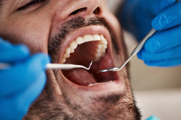 Best Emergency Tooth Extraction in Redwood City, CA