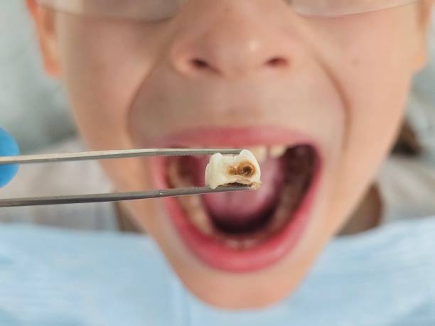 Best Emergency Root Canal Treatment in Redwood City, CA